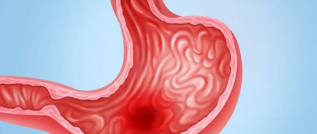 萎縮性胃炎是哪裡(lǐ)萎縮？答案可能(néng)和你想的不一樣(yàng)