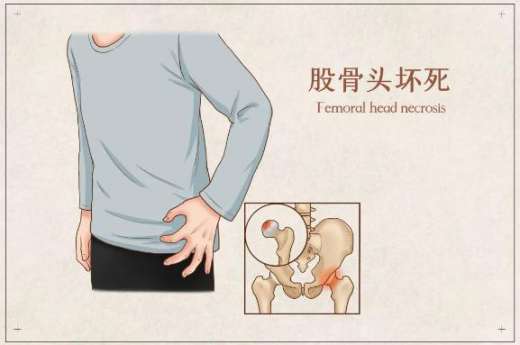 骨科科普|髋關節疼痛不一定是股骨頭壞死