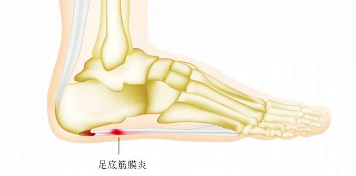 足脊健康說|足底筋膜炎的定義、誘發(fā)因素及自我評測方法